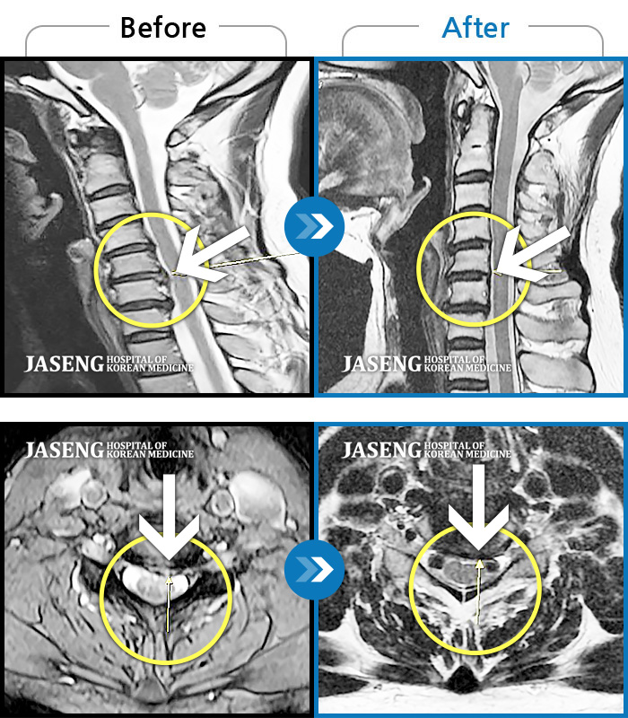 울산자생한방병원 치료사례 MRI로 보는 치료결과-좌측 상완 외측, 하완 외측, 수부 전체 통증 및 저림