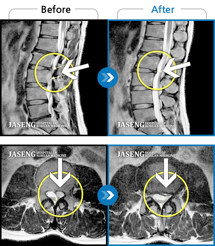 울산자생한방병원 치료사례 MRI로 보는 치료결과-좌측 하요추부 통증과 좌측 대퇴 외측면 저림
