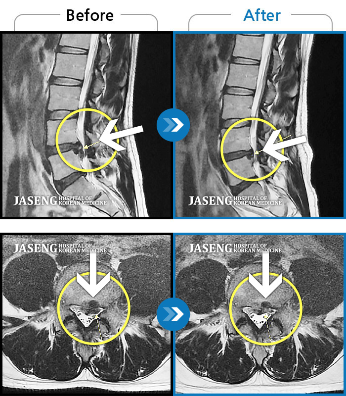 울산자생한방병원 치료사례 MRI로 보는 치료결과-좌측 하요추부 통증과 좌측 하지 후면 통증과 저림