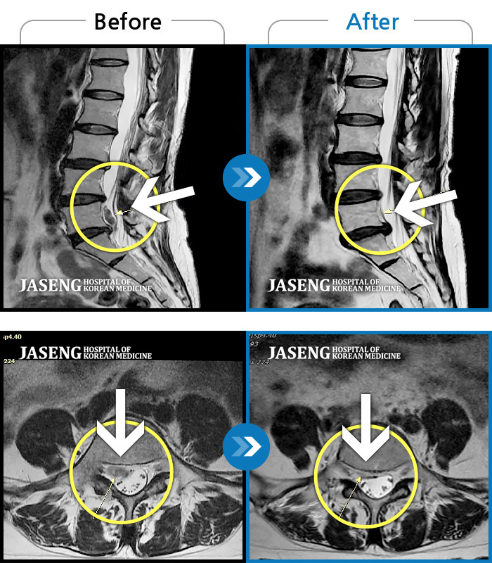 울산자생한방병원 치료사례 MRI로 보는 치료결과-하요추부 통증과 양측 대퇴부 후면 저림