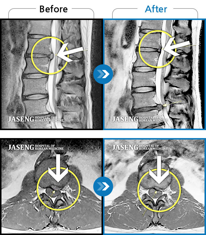 울산자생한방병원 치료사례 MRI로 보는 치료결과-양측 하요추부~좌측 골반부 통증,  좌측 하지 전반적 비증 및 족저부 간헐적 비증