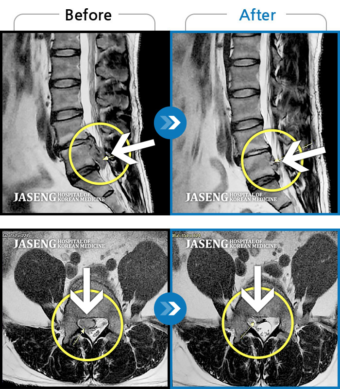 울산자생한방병원 치료사례 MRI로 보는 치료결과-양측 하요추부 통증과 우측 하지 후면부 통증