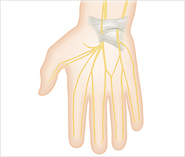 울산자생한방병원 기타관절질환 손목터널증후군-손목터널증후군에 관련된 이미지 입니다.