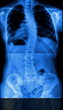 울산자생한방병원 허리질환 척추측만증-척추측만증에 관련된 이미지 입니다.