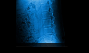 울산자생한방병원 허리질환 척추후만증-척추후만증에 관련된 이미지 입니다.