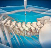 울산자생한방병원 허리치료법 신경근회복술-신경근회복술의 특징 두번째 관련 사진 입니다.