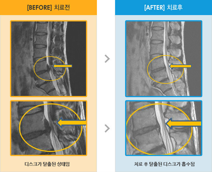자생한방병원 치료사례 MRI로 보는 치료결과-허리 통증, 우하지 방사통 저림