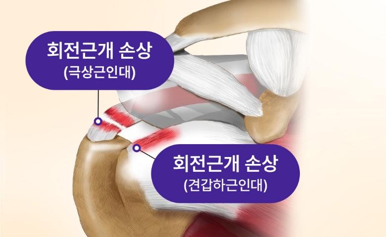 회전근개된 손상된 어깨 일러스트